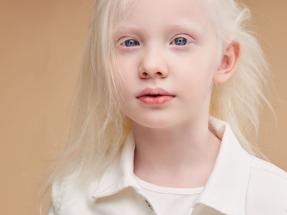 негр и азиат альбинос фото 80