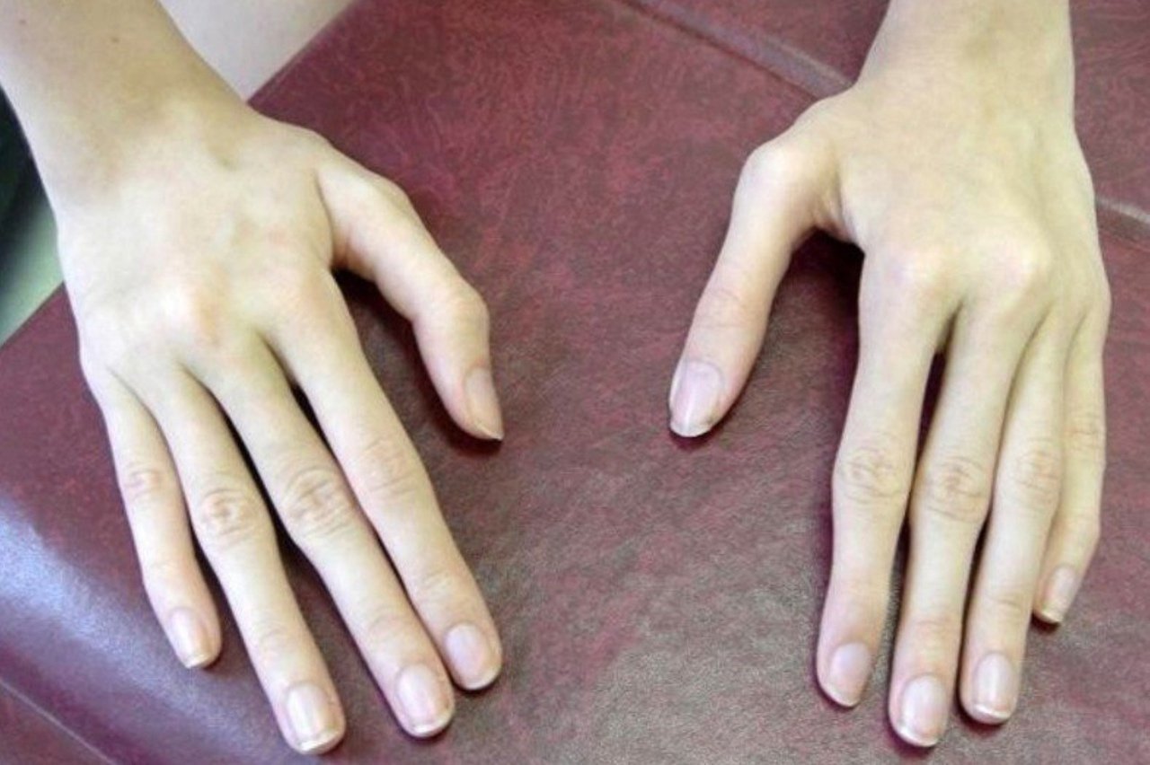 Пальцы стали толще. Синдром Марфана (арахнодактилия). Паучьи пальцы синдром Марфана. Длинные пальцы синдром Марфана. Синдром Марфана паучьи пальцы, арахнодактилия.